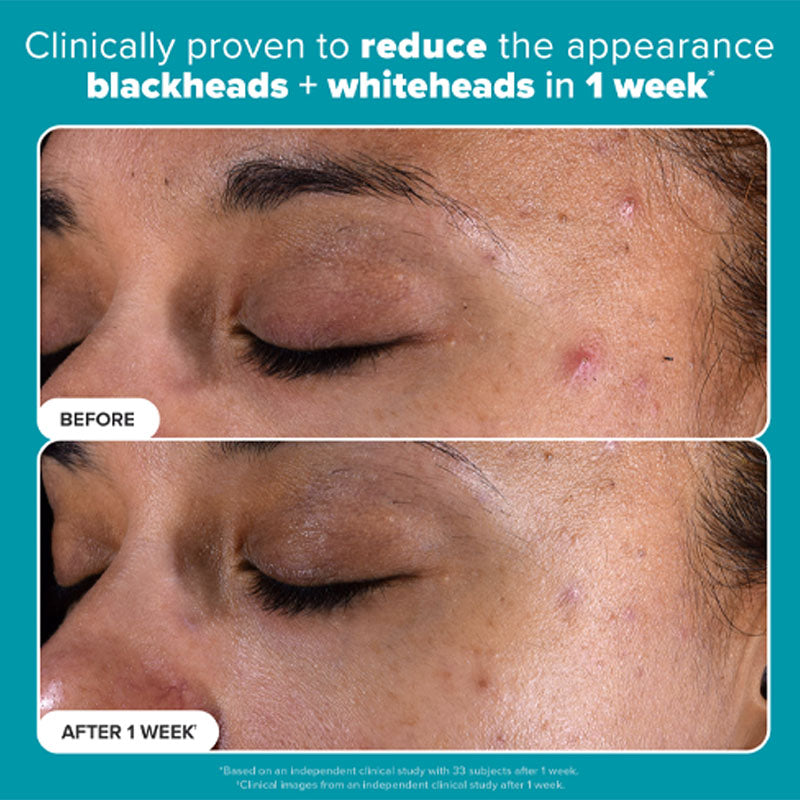 Bha Rashed Skin Perfecting 2% BHA Exfoliating Pads – Paula's Choice Philippines